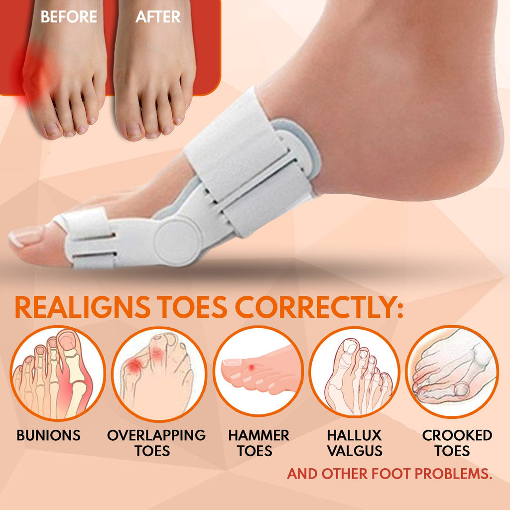 3D Bunion Splint Corrector Device