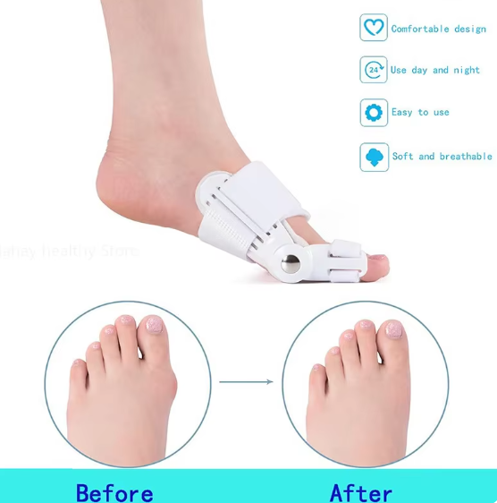 3D Bunion Splint Corrector Device